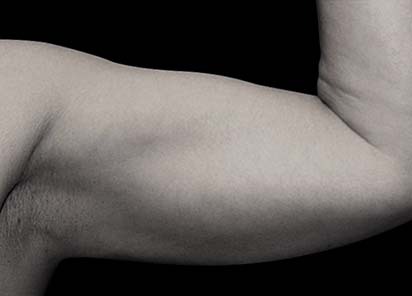 Emsculpt_PIC_076-After-arms-female-Reminder-Saluja-MD-3W-4TX__412x296px_1589434136_original_New_1713509154_original