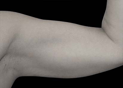 Emsculpt_PIC_076-Before-arms-female-Reminder-Saluja-MD__412x296px_1589434139_original_New_1713509154_original