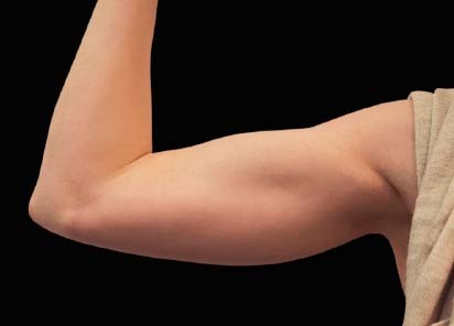 Emsculpt_PIC_078-After-biceps-female-Reminder-Saluja-MD-md-4TX__412x296px_1589434141_original_New_1713509155_original