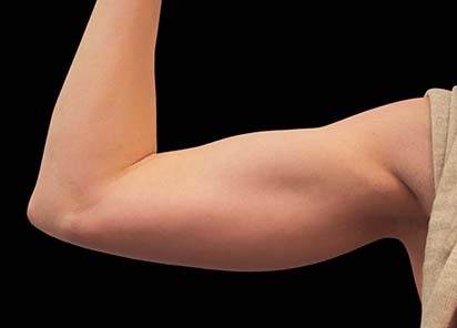 Emsculpt_PIC_078-After-biceps-female-Reminder-Saluja-MD-md-4TX__412x296px_1616750690_original_New_1713441544_original