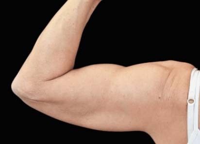 Emsculpt_PIC_080-After-biceps-female-Bruce-E-Katz-MD-4TX_412x296_1589434146_original_New_1713509157_original