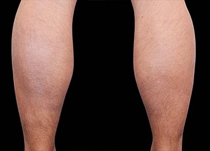 Emsculpt_PIC_082-Before-calves-male-Reminder-Saluja-MD_412x296_1589435000_original_New_1713509694_original