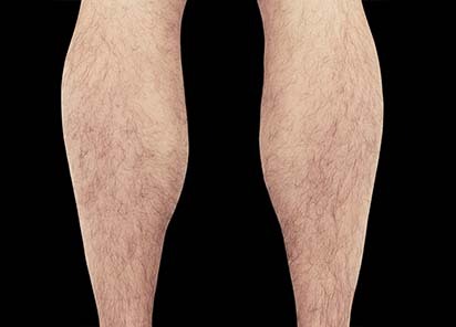 Emsculpt_PIC_083-Before-calves-male-Reminder-Saluja-MD_412x296_1589435002_original_New_1713509695_original