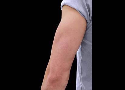 Emsculpt_PIC_085-after-triceps-male-Reminder-Saluja-MD-4TX_412x296_1589434426_original_New_1713510770_original