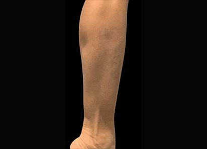 Emsculpt_PIC_087-Before-calves-female-Reminder-Saluja-MD_412x296px_1602658340_original_New_1713443311_original