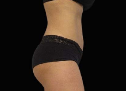 Emsculpt_PIC_093-After-abdomen-female-Michaela-Persky-MD_412x296px_1602658254_original_1713442026_original