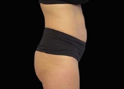 Emsculpt_PIC_093-Before-abdomen-female-Michaela-Persky-MD_412x296px_1602658256_original_1713442025_original