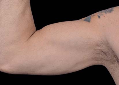 Emsculpt_PIC_098-after-biceps_male-Barry-DiBernardo-MD-4TX_412x296px_1616750693_original_New_1713441543_original