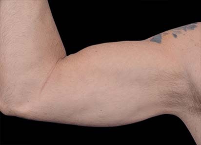 Emsculpt_PIC_098-before-biceps_male-Barry-DiBernardo-MD-4TX_412x296_1616750688_original_New_1713441542_original