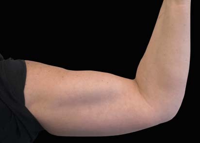 Emsculpt_PIC_113-before-biceps_female-BTL-Aesthetics_412x296px_1589434154_original_New_1713509158_original