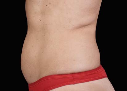 1 MONTH AFTER THE LAST TREATMENT, COURTESY OF: David Kent, M.D.