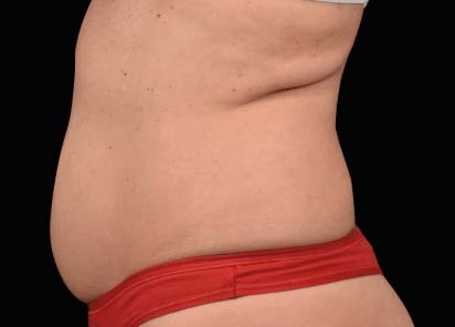 1 MONTH AFTER THE LAST TREATMENT, COURTESY OF: David Kent, M.D.