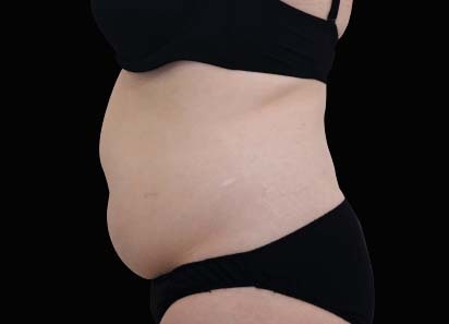 1 MONTH AFTER THE LAST TREATMENT, COURTESY OF: David Kent, M.D.