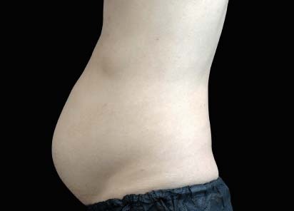 1 MONTH AFTER THE LAST TREATMENT, COURTESY OF: David Kent, M.D.