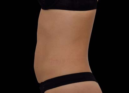 1 MONTH AFTER THE LAST TREATMENT, COURTESY OF: Bruce E. Katz, M.D.