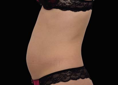 Emsculpt_neo_PIC_023-before-abdomen-female-Bruce-E-Katz-MD__412x296px_1602587294_original_1713438546_original