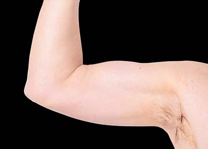 Emsculpt_neo_PIC_027-after-arms-male-Bruce-E-Katz-MD-3M_412x296px_1602658154_original_New_1713441541_original