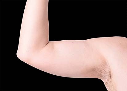 Emsculpt_neo_PIC_027-before-arms-male-Bruce-E-Katz-MD__412x296px_1602658157_original_New_1713441540_original