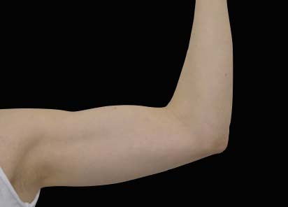 Emsculpt_neo_PIC_028-after-arms-female-Bruce-E-Katz-MD-3M__412x296px_1602658160_original_New_1713441542_original