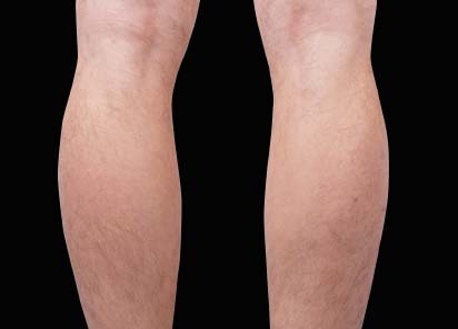 Emsculpt_neo_PIC_030-before-calves-male-Bruce-E-Katz-MD__412x296px_1602680599_original_New_1713443310_original