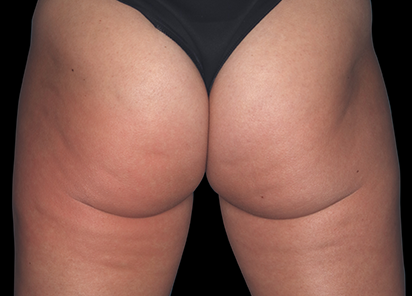 Emtone_PIC_001-After-buttock-female-Marc-Salzman-MD-4TX_412x296_1589436992_original