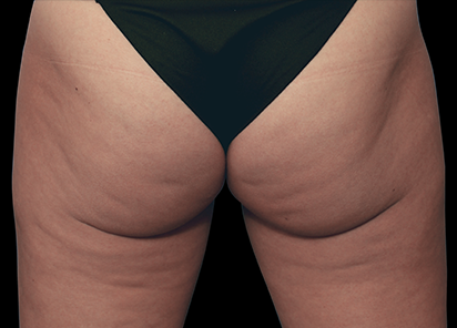 Emtone_PIC_001-Before-buttock-female-Marc-Salzman-MD_412x296_1589436994_original