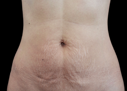 Emtone_PIC_002-After-abdomen-female-Klaus-Fritz-MD-4TX_412x296_1589436686_original