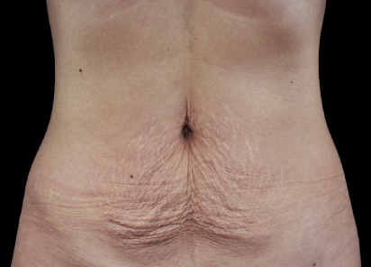 Emtone_PIC_002-Before-abdomen-female-Klaus-Fritz-MD_412x296_1589436688_original