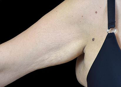 Emtone_PIC_005-After-arm-female-BTL-Aesthetics-4TX_412x296_1589436816_original