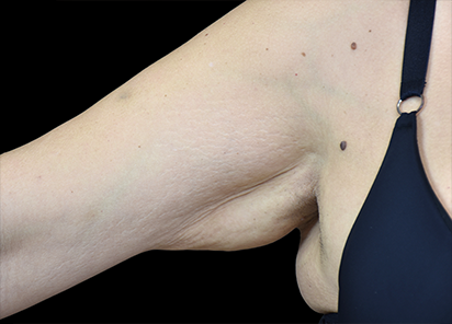 Emtone_PIC_005-Before-arm-female-BTL-Aesthetics_412x296_1589436817_original