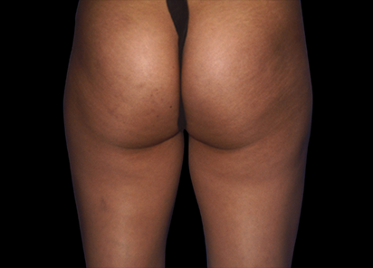 Emtone_PIC_006-After-buttock-female-Marianno-Busso-MD-4TX_412x296_1589783314_original