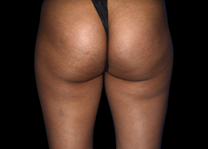 Emtone_PIC_006-Before-buttock-female-Marianno-Busso-MD_412x296_1589783316_original