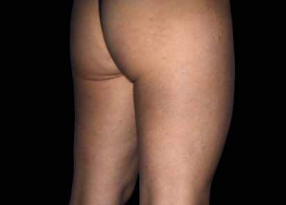 Emtone_PIC_007-After-buttock-female-Marianno-Busso-MD-4TX_412x296_1589785401_original