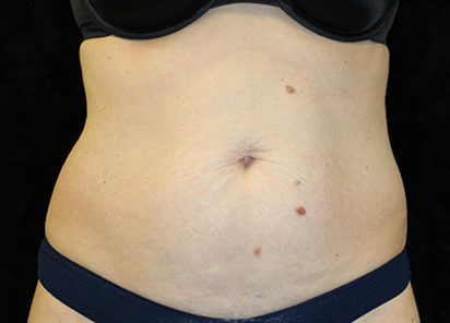 Emtone_PIC_008-After-abdomen-female-Ann-Watwood-NMD-4W-4TX_412x296_1589782972_original