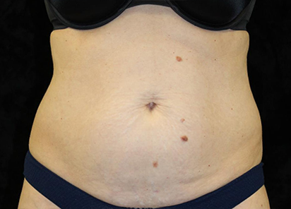 Emtone_PIC_008-Before-abdomen-female-Ann-Watwood-NMD_412x296_1589782975_original