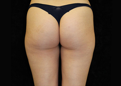 Emtone_PIC_009-After-buttock-female-Ann-Watwood-NMD-8W-4TX_412x296_1589783317_original