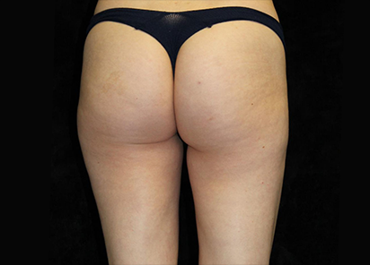 Emtone_PIC_009-Before-buttock-female-Ann-Watwood-NMD_412x296_1589783320_original