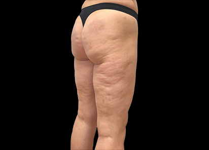 Emtone_PIC_010-Before-buttock-female-Giulia-Bianchi_412x296_1589783326_original