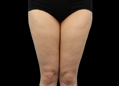 Emtone_PIC_012-After-legs-female-Dr-Hayre_412x296_1589785403_original