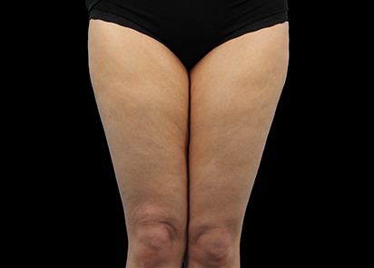 Emtone_PIC_012-Before-legs-female-Dr-Hayre_412x296_1589785405_original