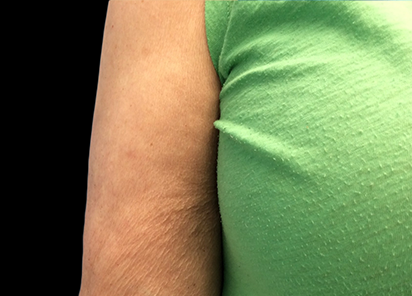 Emtone_PIC_013-After-arms-female-Dr-Hayre_412x296_1589783139_original