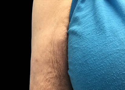 Emtone_PIC_013-Before-arms-female-Dr-Hayre_412x296_1589783141_original