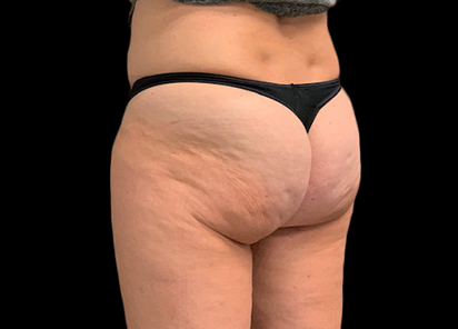 Emtone_PIC_014-Before-buttock-female-PDC-Heather_Fitzgerald_412x296_1589783331_original