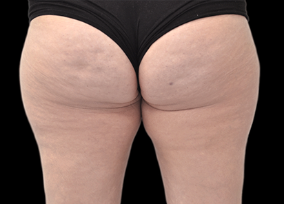 Emtone_PIC_018-After-buttock-female-BTL-Aesthetics-3M-4TX_412x296_1589783338_original