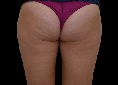 Emtone_PIC_019-Before-buttock-female-Tania-Rashid_412x296_1589783345_original