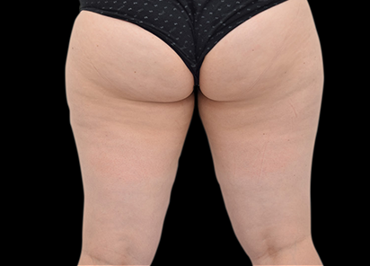 Emtone_PIC_021-Before-buttock-female-Melissa-French_412x296_1589783349_original