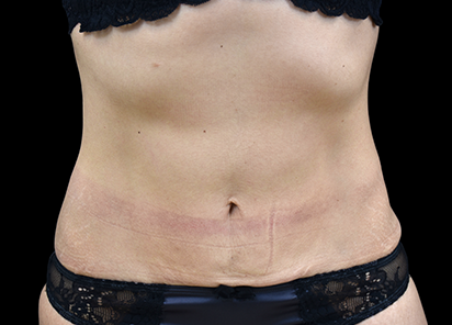 Emtone_PIC_023-After-abdomen-female-Klaus-Fritz-3M-4TX_412x296px_1589782977_original