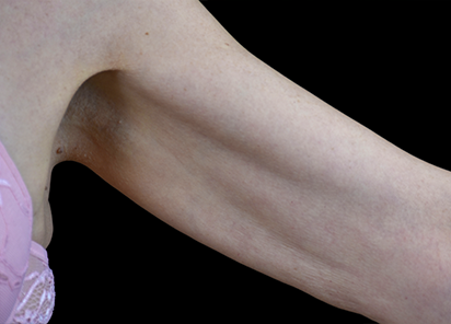 Emtone_PIC_024-After-arms-female-BTL-Aesthetics-4TX_412x296_1589783142_original