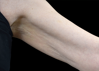 Emtone_PIC_024-Before-arms-female-BTL-Aesthetics_412x296_1589783144_original