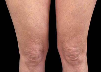 Emtone_PIC_025-After-legs-female-BTL-Aesthetics-4TX_412x296_1589437105_original